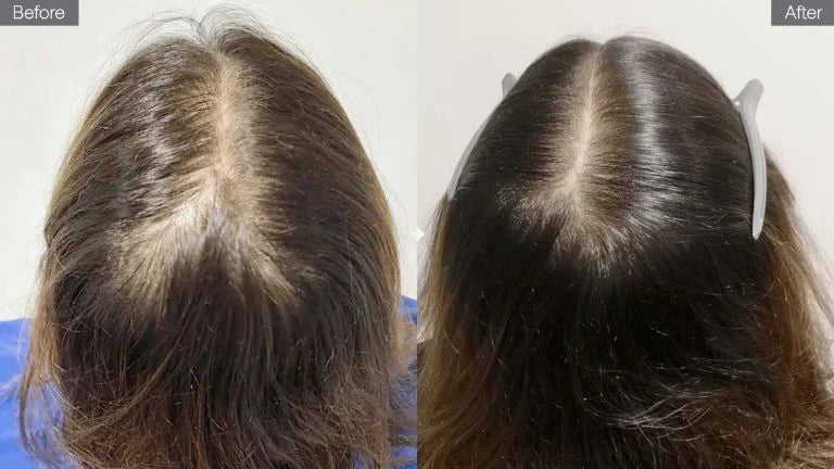 files/1700819716-Thinning-hair-Receding-hairline-This-micro-needling-scalp-treatment-promotes-hair-growth-SLIDER.webp